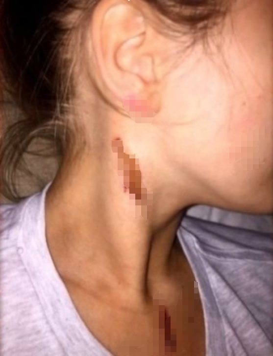 英国泼酸袭击 Acid Attacks How Scared Should We Be插图